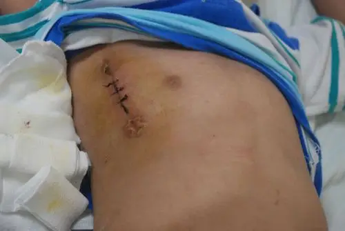 腋下小切口室间隔缺损修补术后