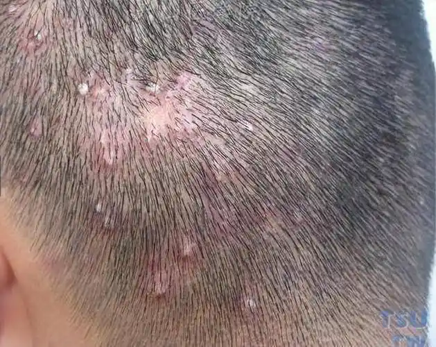 原创为啥头皮上总长出脓包和疙瘩医生暗示3种病需要考虑
