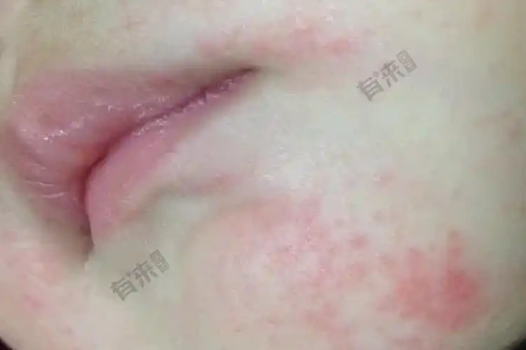 婴儿亚急性湿疹图