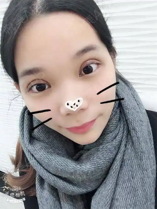 全切双眼皮术后32天_双眼皮术后32天_眼部整形术后32天_悦mer