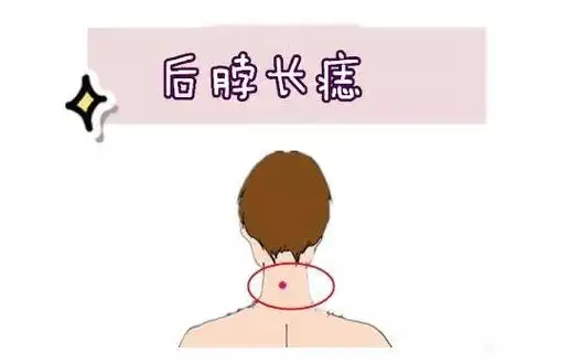 5大靠山痣后背有痣有靠山