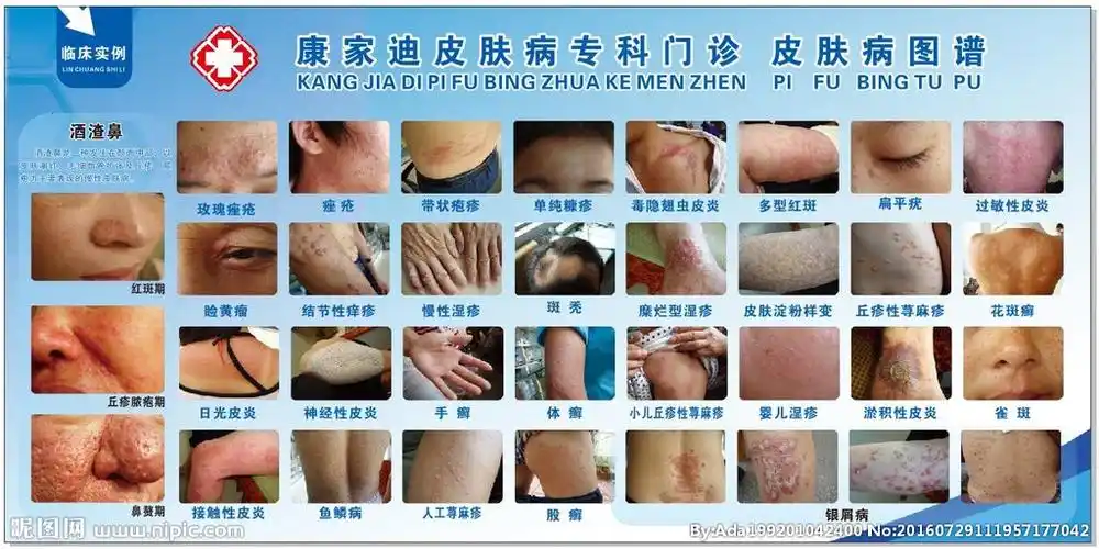 皮肤病展板图片