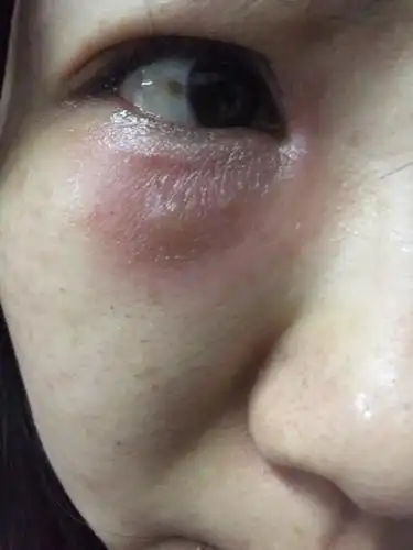 问:昨天中午饭后眼周痒揉眼后周围皮肤出现了红肿瘙痒眼内分泌物黄色