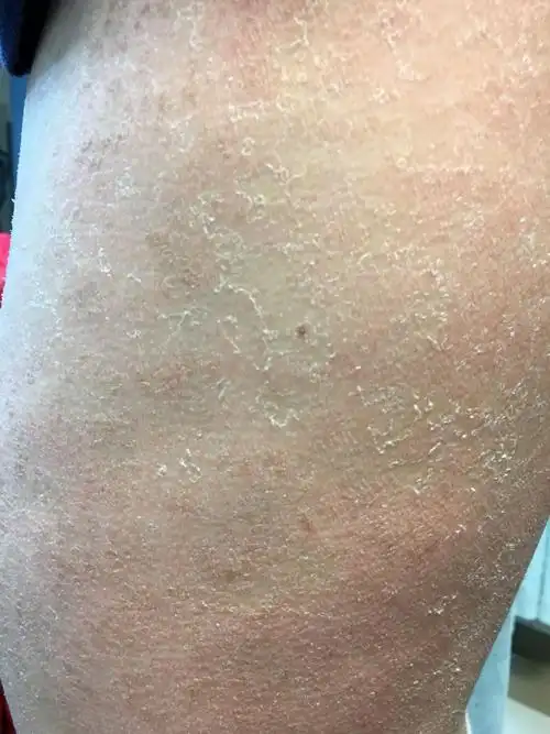 冬季不仅是老年人的皮肤干燥,就是年轻人,30岁左右