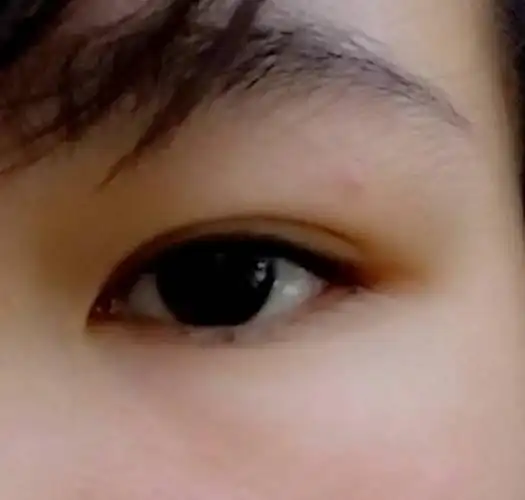 2014-02-02 唐荔霞 护师 我的下眼睑有—颗很小的黑痣,在我很小的