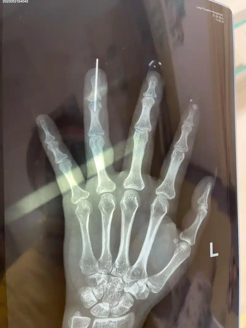 没关系,又活了一天,已经很厉害了.#熬过了就好了 手指头断了 - 抖音