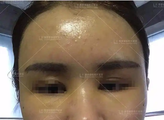 《荃说医美》——脂肪填充失败的症状有哪些?