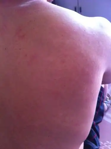 很痒,红点褪去后就变成白斑,很多年了,请问是什么皮肤病?