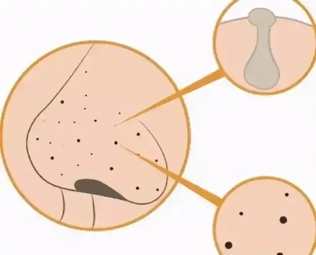 医学美容能解决皮肤毛孔粗大的问题吗?对皮肤有没有伤害?