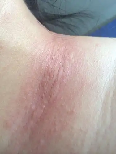 今年28岁,脖子的皮肤特别容易过敏,起一层小疙瘩很痒,一挠就红… 毛孔