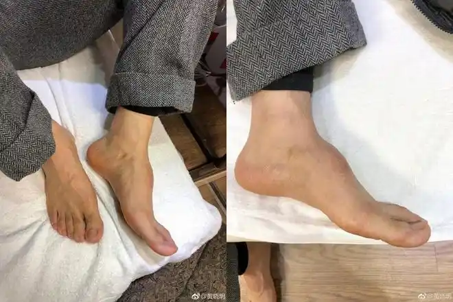 黄晓明晒脚背照回应鞋垫质疑:事故后组织增生