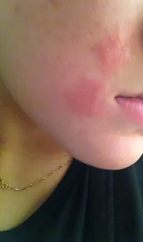 我的脸过敏一个月了,没有查出过敏原,刚开