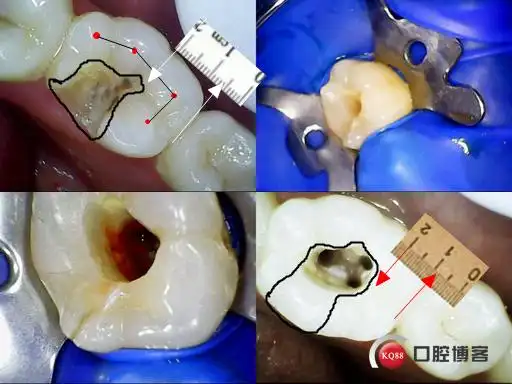 根管的第一道难关入路