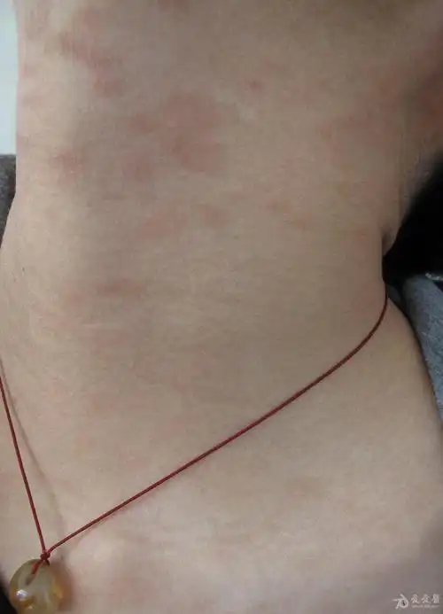皮肤病颈部皮疹近两个月