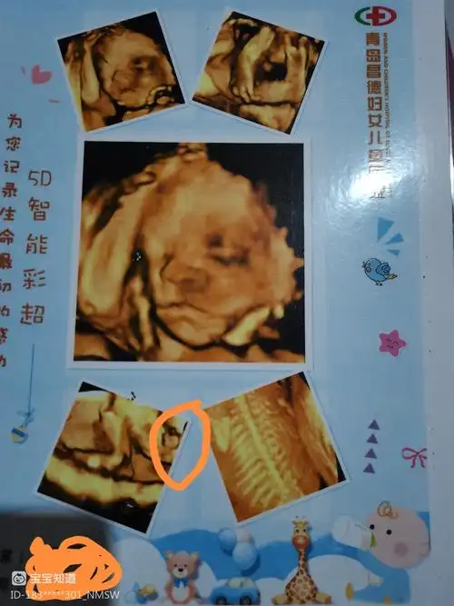 四维彩超看男女 - 百度宝宝知道