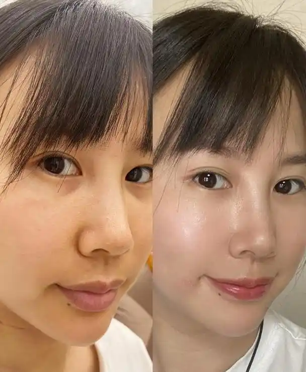 胶原大白微针有那么神奇吗?