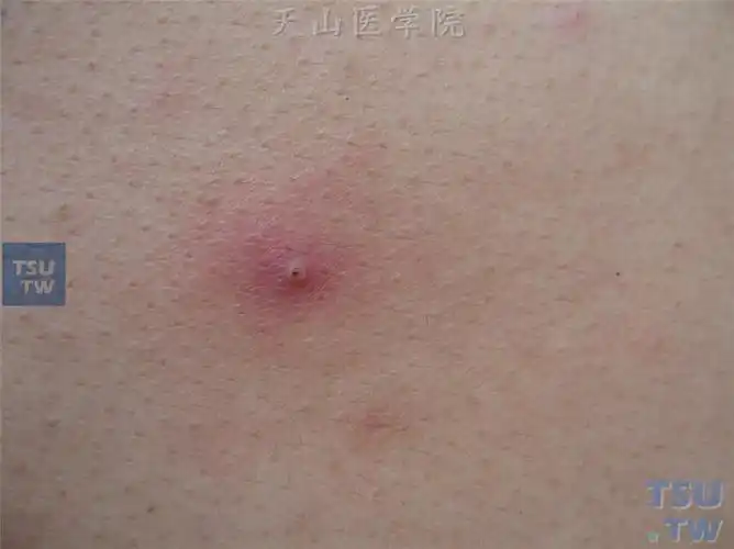 毛囊性炎性丘疹,中央脓疱