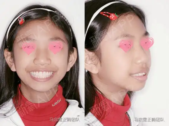 除了影响健康,更会打击孩子的自信心,削减孩子的快乐,12岁牙齿矫正