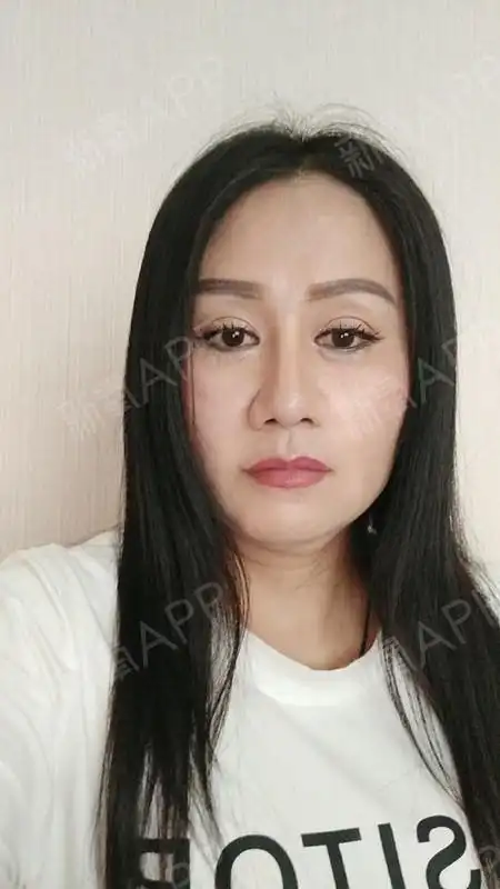 自体脂肪面部填充