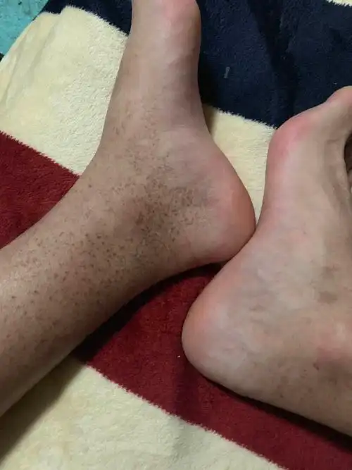 腿上长了好多斑点,不疼不痒的,有两年了,越来越多,是什么东西
