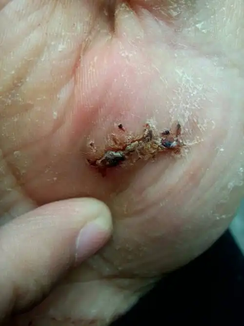 拆了线的伤口一直不愈合,这是怎么回事啊