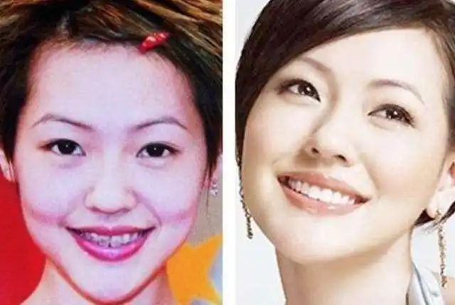 女星整牙前后对比林心如整牙后笑容可人唐嫣从土妞变女神