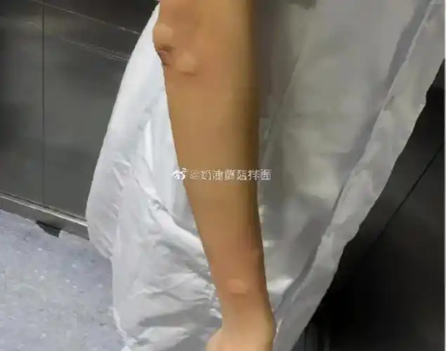 蚊子包的101种形状,再也不想被蚊子咬了