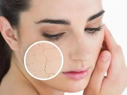 皮肤紧绷干燥!干性肌肤应该如何护理?