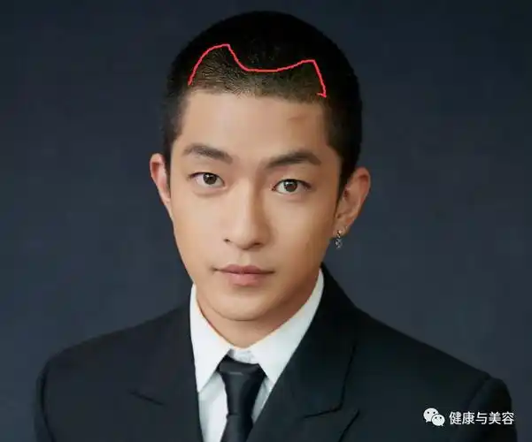 李易峰陈星旭剪寸头难看的m型发际线如何避免