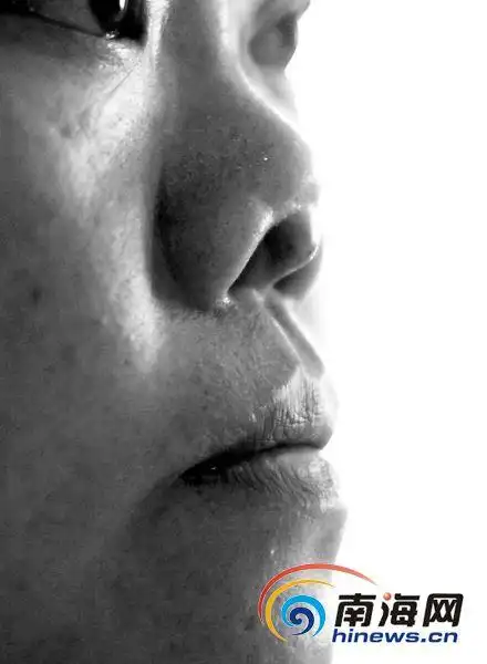 整形手术,没想到3个月前鼻子假体突然开始变形,现在严重发炎红肿凸起