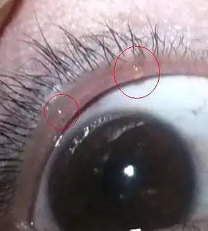 眼皮上长眼疖子怎么办 2 2009-11-05 上眼睑边缘长了一粒白色大疙瘩