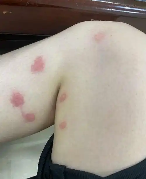 跳蚤咬的包和疤痕多久能消下去能好 跳蚤咬的红疙瘩图片