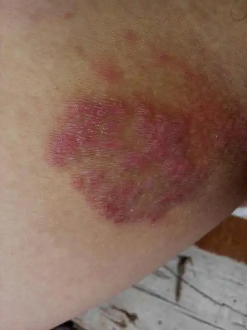 在大腿根部内侧,已经有几个月了,曾经连续一星期阴雨天气没有痒,我就