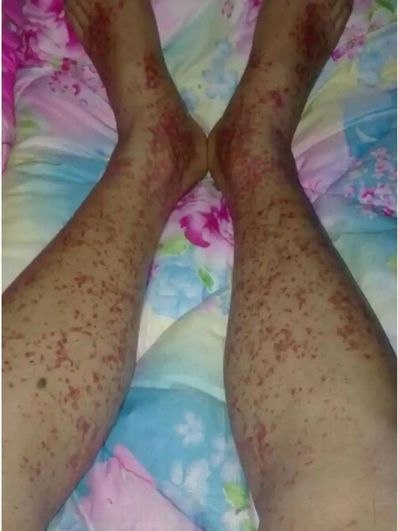 临床上,我们通过鉴别过敏性紫癜的典型症状来进行判断和鉴别.