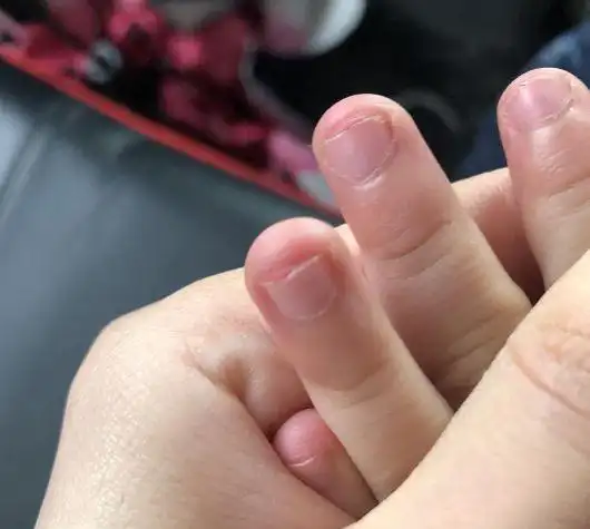 爱啃指甲有危害吗,小孩用苦甲水戒咬指甲安全吗?