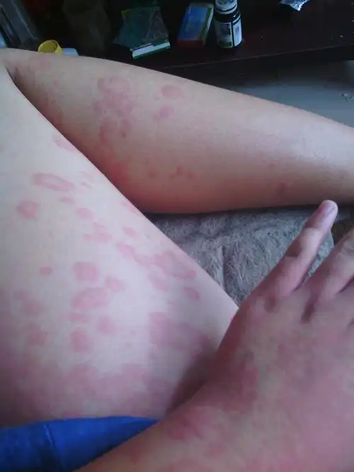 我前几天用了一种护发素,然后过敏了,身上长了一片一片的红疙瘩_皮肤