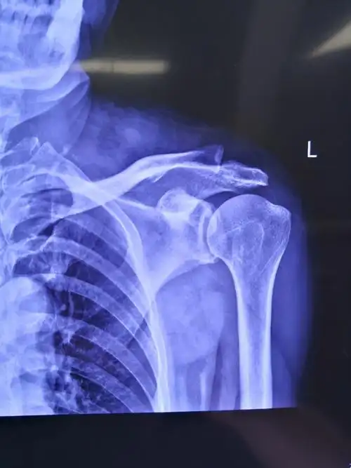 术前左肩关节正位片提示:左肱骨大结节处骨赘形成(肩峰撞击引起)