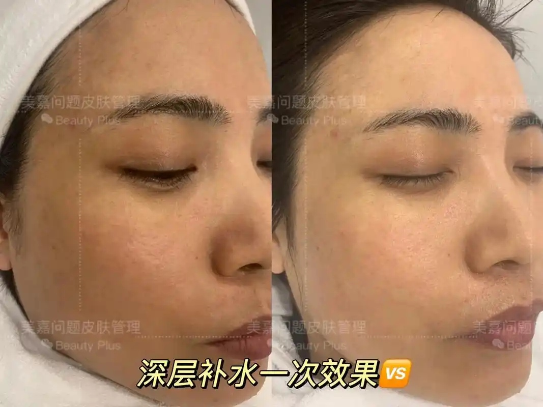 色素沉着,肤色暗黄一次改善#皮肤差 #每日护肤 #脸部护理 - 抖音