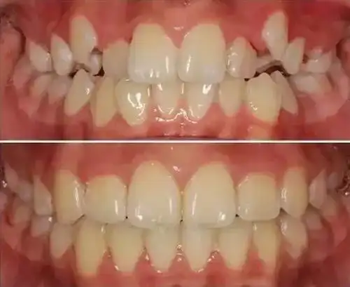 虎牙矫正前后对比图