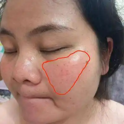 减激素后,脸颊出现红色,很明显的一大块,肉眼可见红血丝,只有右边