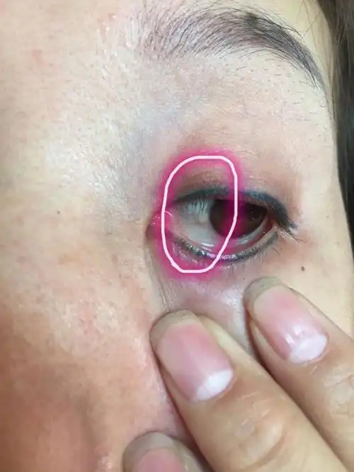 眼睛里白眼球上有个白色的小肉球,是怎么回事啊?