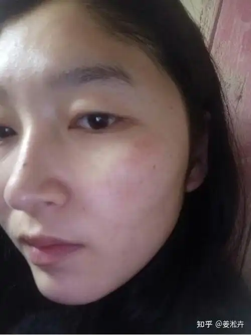 脸上有红血丝,医生说要用激光打掉,会有副作用吗?