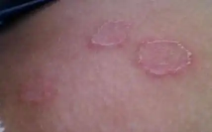 女性淋病吃什么药 女性淋病的早期症状 淋病女性早期症状 慢性淋病