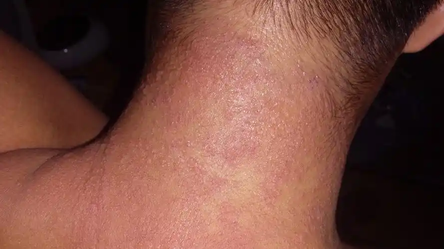 后颈部起了好多红红的,有灼热感,痒.是什么病呀