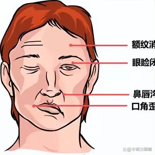 对于面瘫面神经炎的患者来说,走出治疗误区,迈向健康之路,是每一个