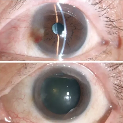 被我院角膜科医生确诊为"左眼复发性翼状胬肉"入院医治