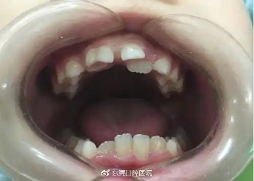 孩子竟然长出双排牙,家长们该怎么办?