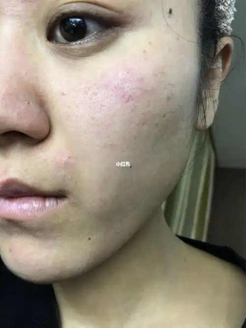 我的脸用啥都不爱吸收,皮肤太差太差了_水乳_皮肤问题_补水面膜_面膜