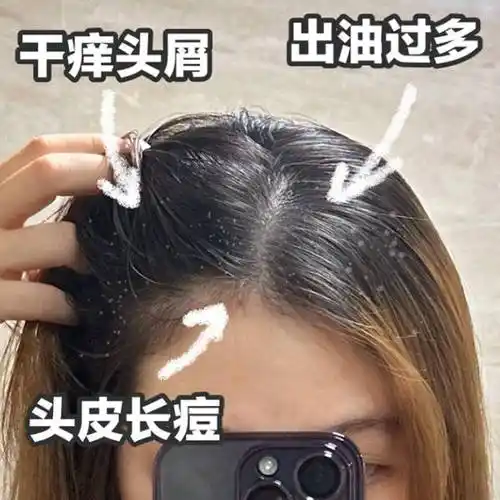 头痒头屑脱发严重怎样治疗?去屑蓬松洗发水介绍_头皮屑_头发_效果