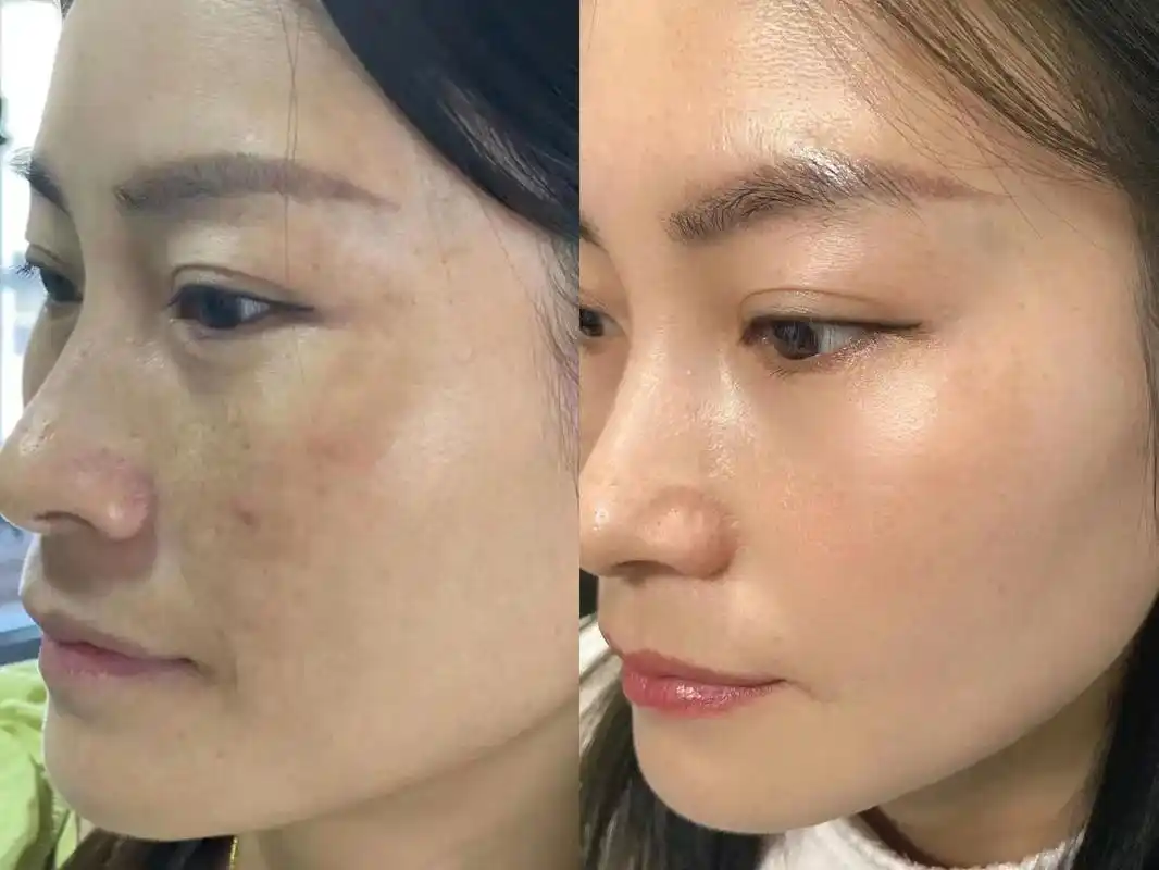 做完皮肤管理前后的对比这效果简直不要太好了素颜都好看